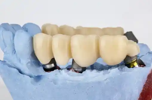 How Full Arch Bridges Can Transform Your Smile